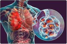 న్యూమోనియా మరియు పార్కిన్సన్ వ్యాధి