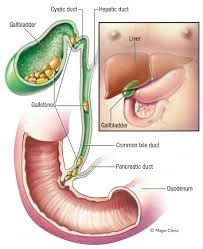 Medical illustration of the gallbladder showing bile ducts, gallstones, and how stones form inside the gallbladder
