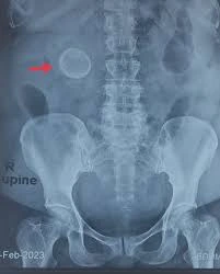 Abdominal X-ray image showing presence of gallstones in the gallbladder region, used for diagnosis of cholelithiasis